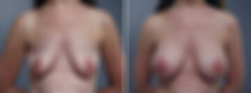 Breast Augmentation Before and After Photos in Princeton, NJ, Patient 23060