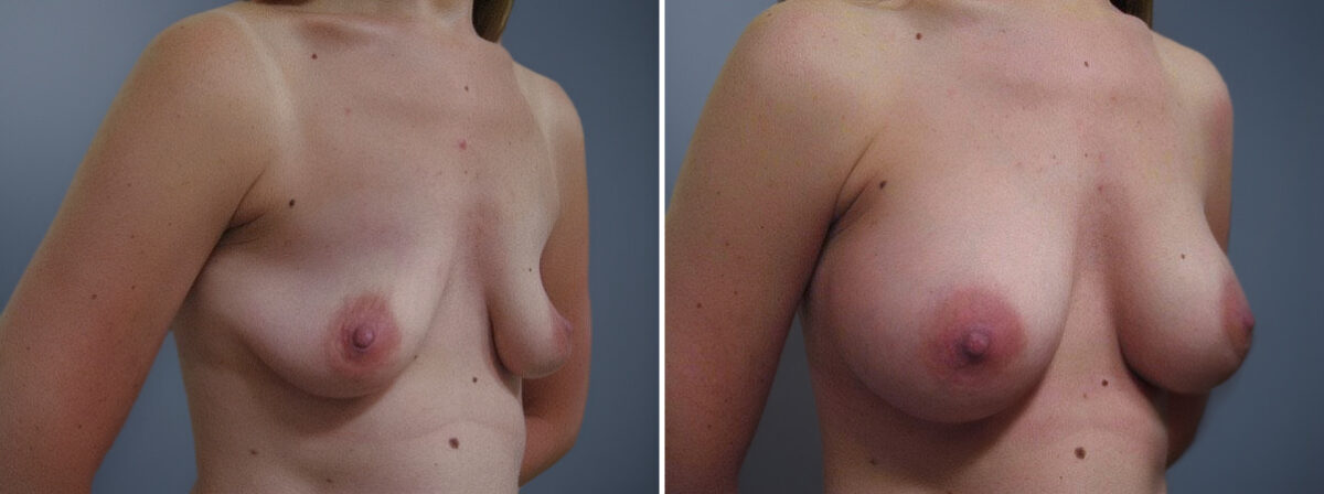 Breast Augmentation Before and After Photos in Princeton, NJ, Patient 23060