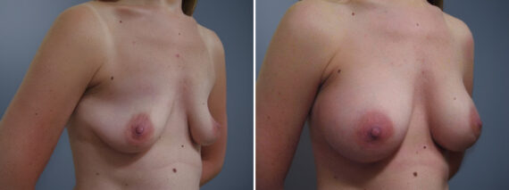 Breast Augmentation Before and After Photos in Princeton, NJ, Patient 23060