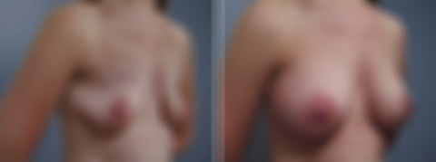 Breast Augmentation Before and After Photos in Princeton, NJ, Patient 23060