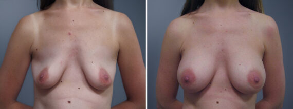 Breast Augmentation Before and After Photos in Princeton, NJ, Patient 23060