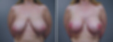 Breast Augmentation Before and After Photos in Princeton, NJ, Patient 23077