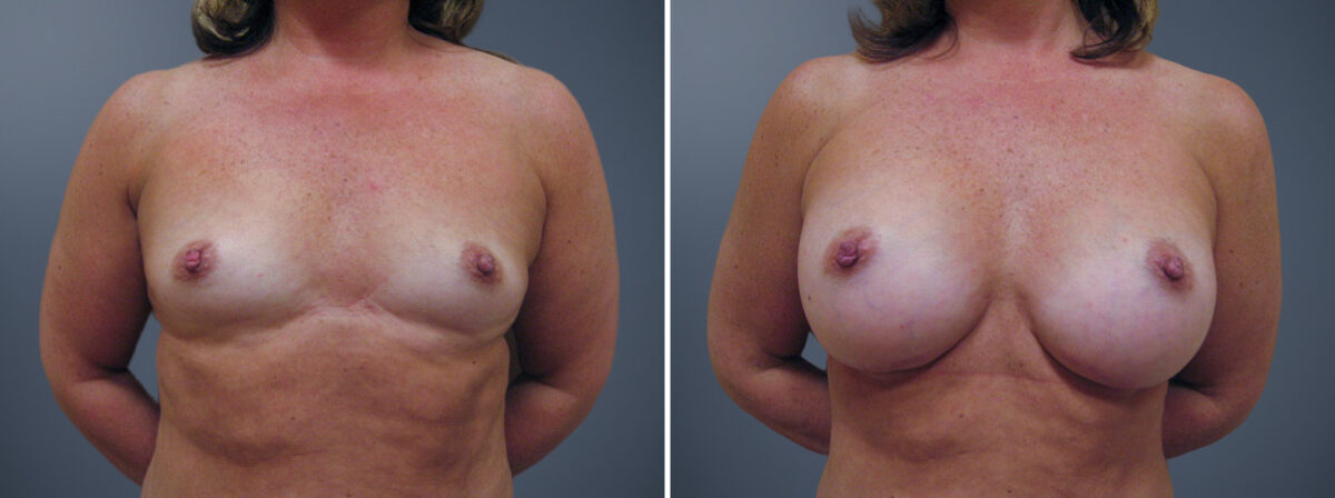 Breast Augmentation Before and After Photos in Princeton, NJ, Patient 23084