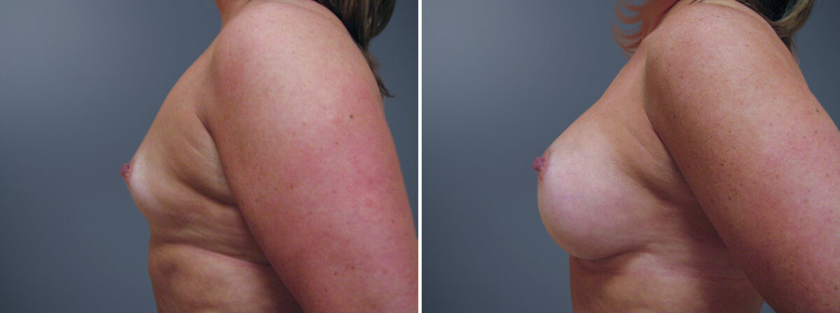 Breast Augmentation Before and After Photos in Princeton, NJ, Patient 23084