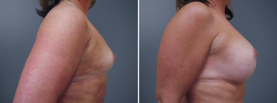 Breast Augmentation Before and After Photos in Princeton, NJ, Patient 23084