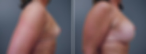 Breast Augmentation Before and After Photos in Princeton, NJ, Patient 23084