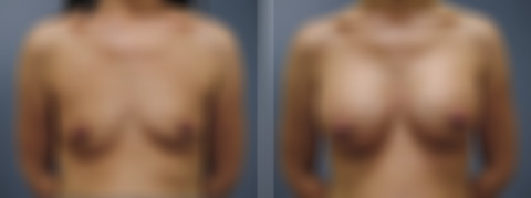 Breast Augmentation Before and After Photos in Princeton, NJ, Patient 23101