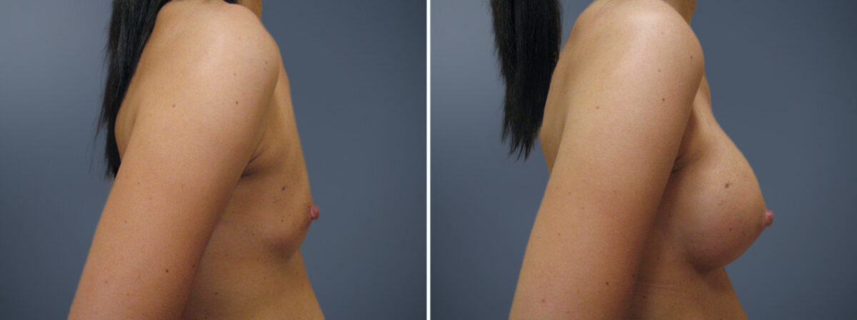 Breast Augmentation Before and After Photos in Princeton, NJ, Patient 23101