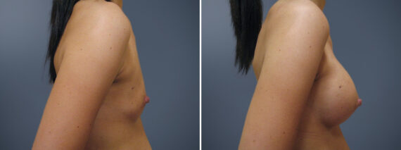 Breast Augmentation Before and After Photos in Princeton, NJ, Patient 23101