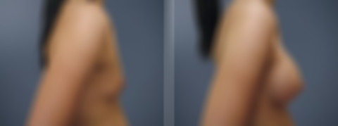 Breast Augmentation Before and After Photos in Princeton, NJ, Patient 23101