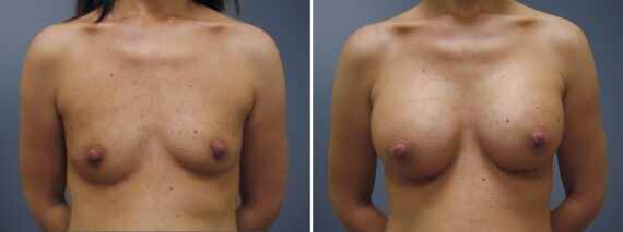 Breast Augmentation Before and After Photos in Princeton, NJ, Patient 23101