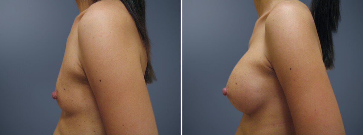 Breast Augmentation Before and After Photos in Princeton, NJ, Patient 23101