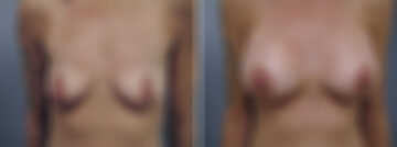 Breast Augmentation Before and After Photos in , , Patient 23122