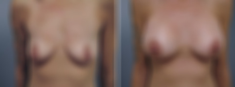 Breast Augmentation Before and After Photos in , , Patient 23122