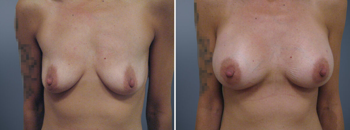 Breast Augmentation Before and After Photos in , , Patient 23122