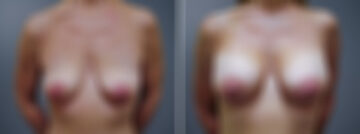 Breast Augmentation Before and After Photos in Princeton, NJ, Patient 23129