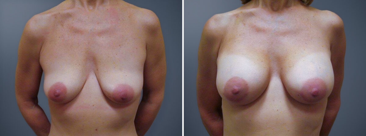 Breast Augmentation Before and After Photos in Princeton, NJ, Patient 23129