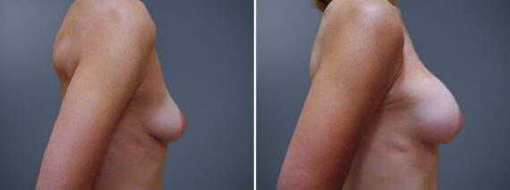 Breast Augmentation Before and After Photos in Princeton, NJ, Patient 23129