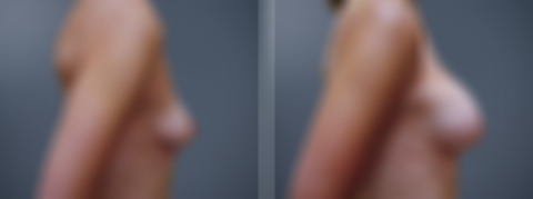 Breast Augmentation Before and After Photos in Princeton, NJ, Patient 23129