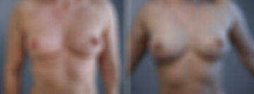 Fat Transfer Breast Augmentation Before and After Photos in Princeton, NJ, Patient 23146