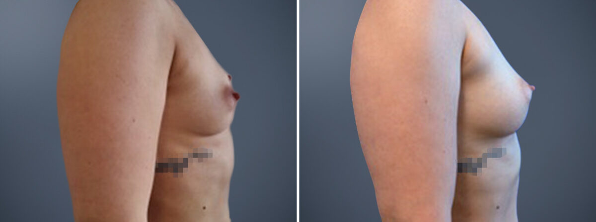 Fat Transfer Breast Augmentation Before and After Photos in Princeton, NJ, Patient 23146