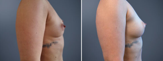Fat Transfer Breast Augmentation Before and After Photos in Princeton, NJ, Patient 23146