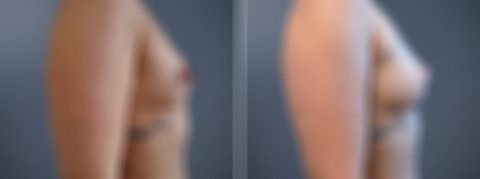 Fat Transfer Breast Augmentation Before and After Photos in Princeton, NJ, Patient 23146