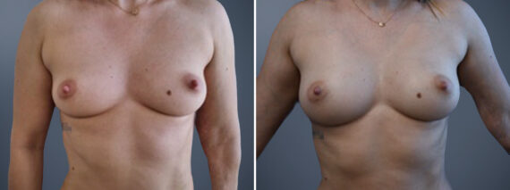 Fat Transfer Breast Augmentation Before and After Photos in Princeton, NJ, Patient 23146