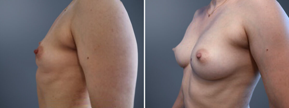 Fat Transfer Breast Augmentation Before and After Photos in Princeton, NJ, Patient 23146