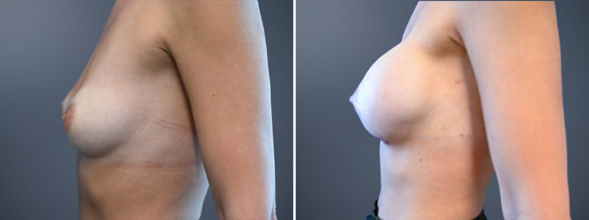 Breast Augmentation Before and After Photos in Princeton, NJ, Patient 23166