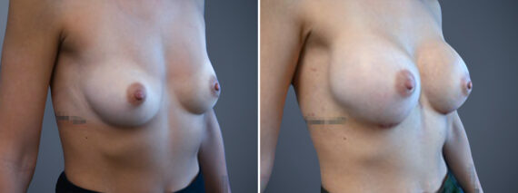 Breast Augmentation Before and After Photos in Princeton, NJ, Patient 23166
