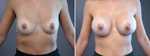 Breast Augmentation Before and After Photos in Princeton, NJ, Patient 23166