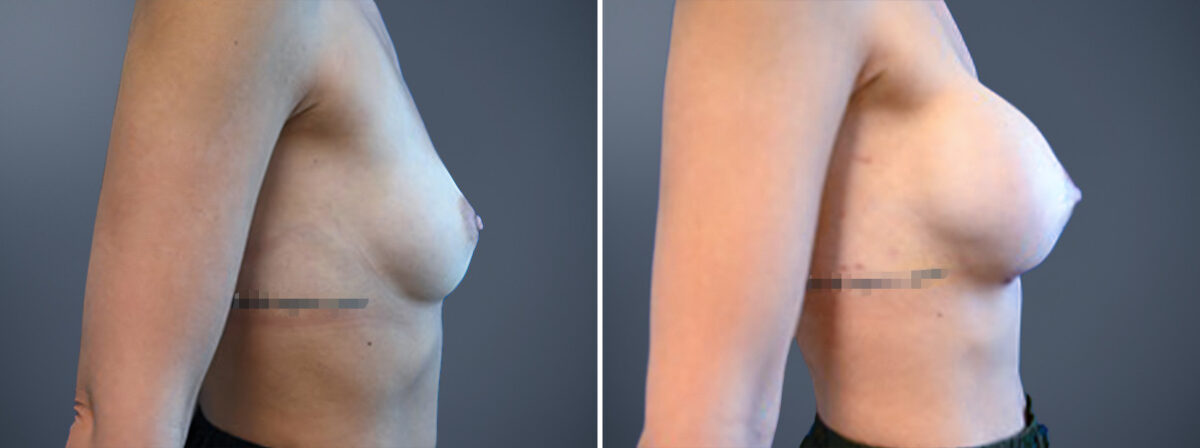 Breast Augmentation Before and After Photos in Princeton, NJ, Patient 23166