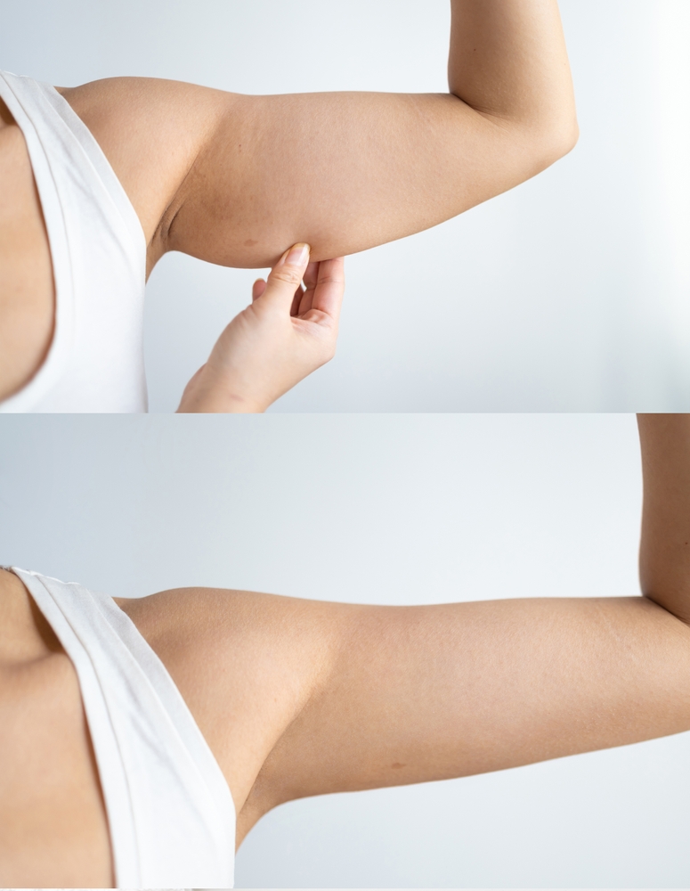 Arm lift results showing scar maturation and final appearance between months six and eighteen
