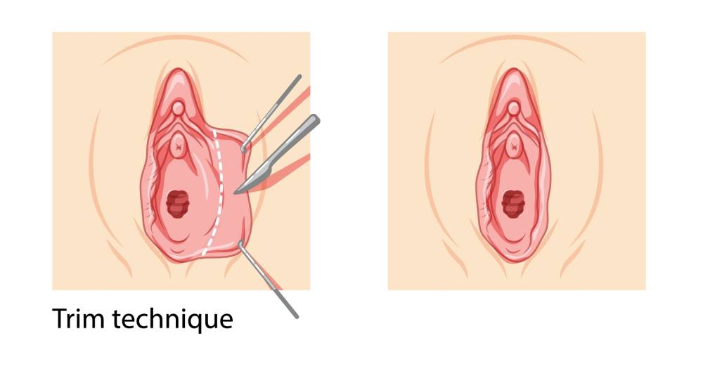 Illustration of the labiaplasty trim technique showing edge resection and labia minora reduction.
