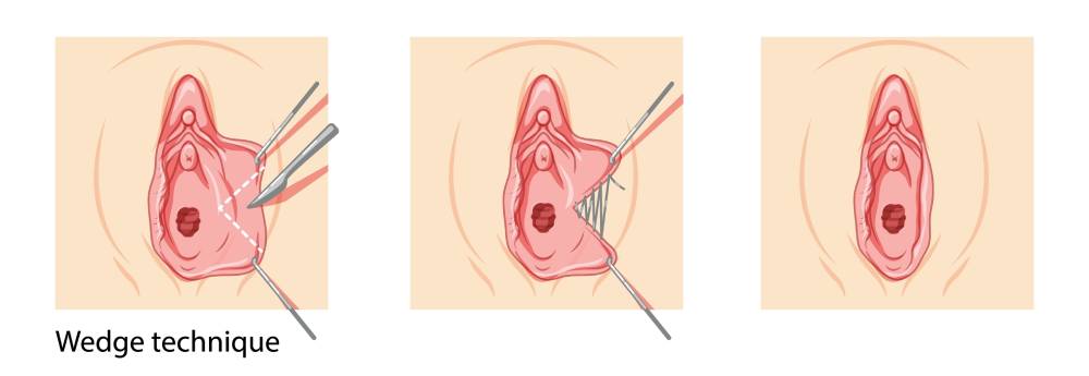 Illustration of the labiaplasty wedge technique showing V-shaped tissue removal and labial edge preservation.