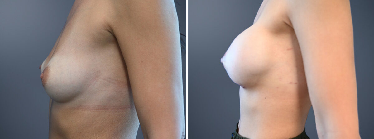 Breast Augmentation Before and After Photos in Princeton, NJ, Patient 23166