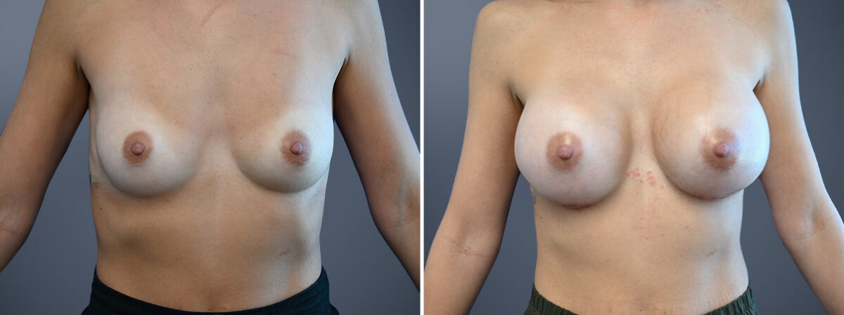 Breast Augmentation Before and After Photos in Princeton, NJ, Patient 23166