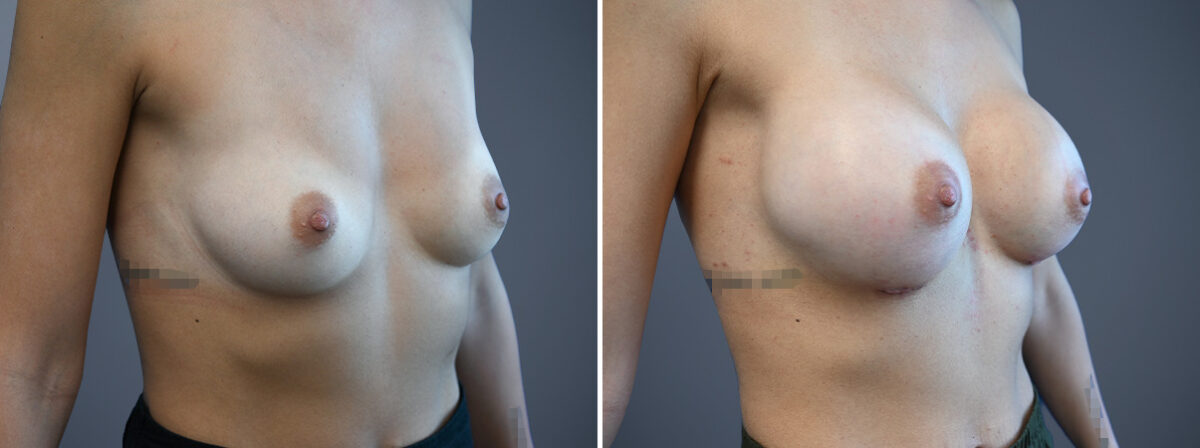 Breast Augmentation Before and After Photos in Princeton, NJ, Patient 23166