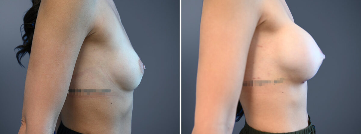 Breast Augmentation Before and After Photos in Princeton, NJ, Patient 23166