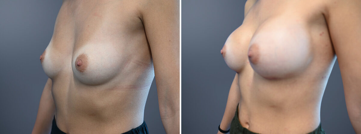Breast Augmentation Before and After Photos in Princeton, NJ, Patient 23166