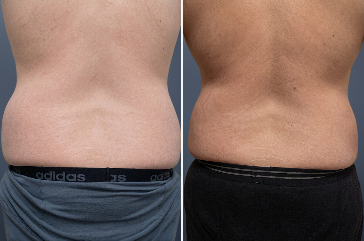 Liposuction Before and After Photos in Princeton, NJ, Patient 23198