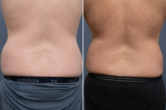 Liposuction Before and After Photos in Princeton, NJ, Patient 23198