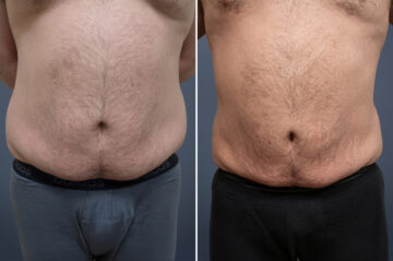 Liposuction Before and After Photos in Princeton, NJ, Patient 23198