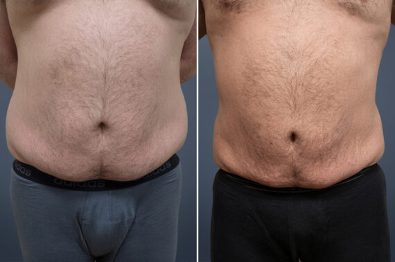 Liposuction Before and After Photos in Princeton, NJ, Patient 23198