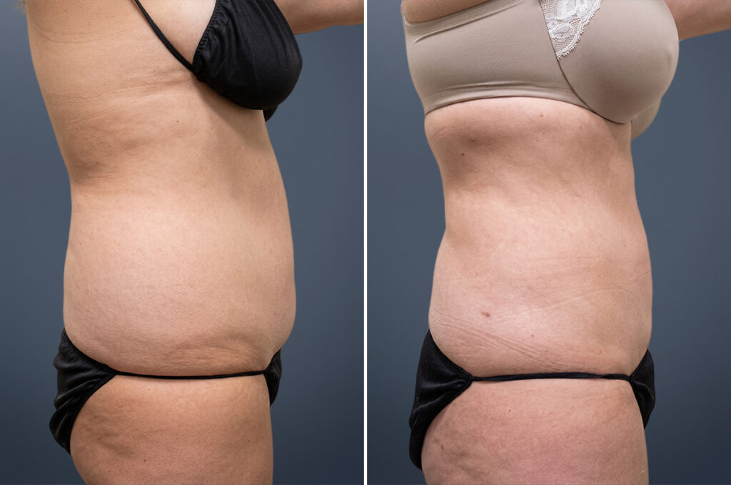 Liposuction patient before & after photo
