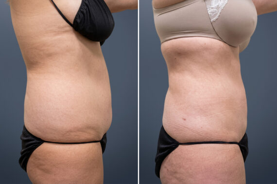 Liposuction Before and After Photos in Princeton, NJ, Patient 23205