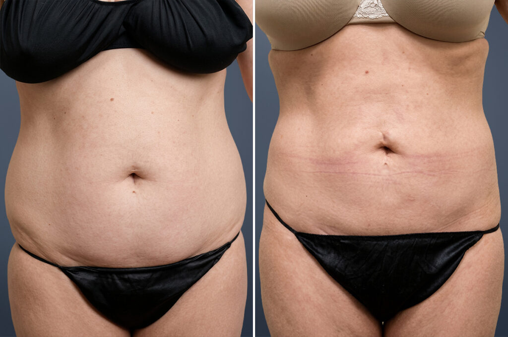 Liposuction patient before & after photo