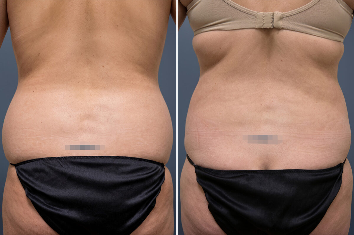 Liposuction Before and After Photos in Princeton, NJ, Patient 23205