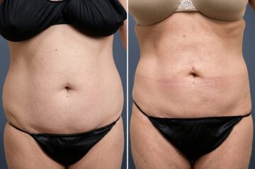 Liposuction Before and After Photos in Princeton, NJ, Patient 23205